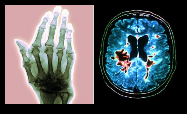 Paleo un autoimūnie stāvokļi: saišu izpēte